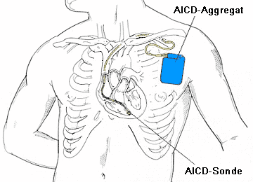 Defibrillatorimplantation